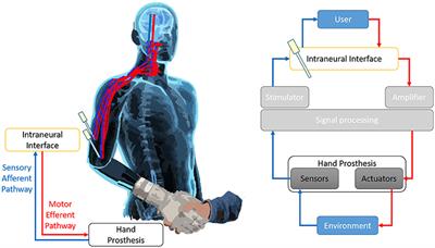 Invasive Intraneural Interfaces: Foreign Body Reaction Issues